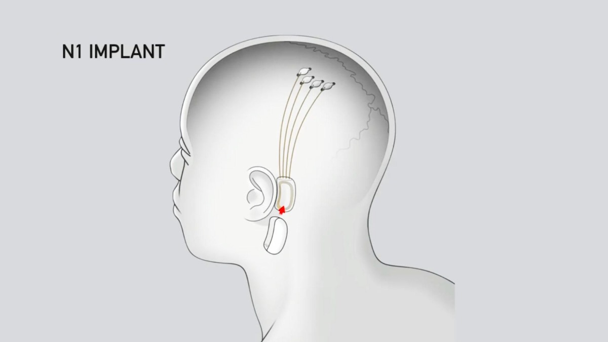 Elon Musk’s Neuralink Brain Chip Implanted in First Live Human